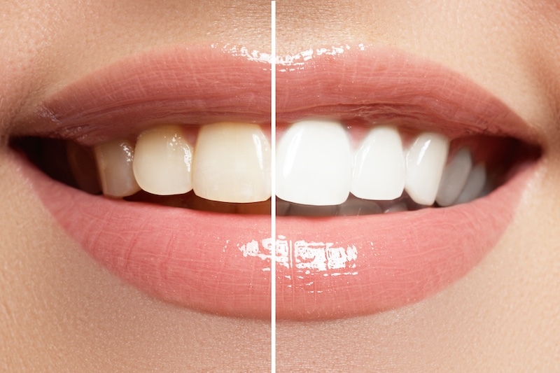 teeth whitening Campbell Dental Arts dentist in escondido ca