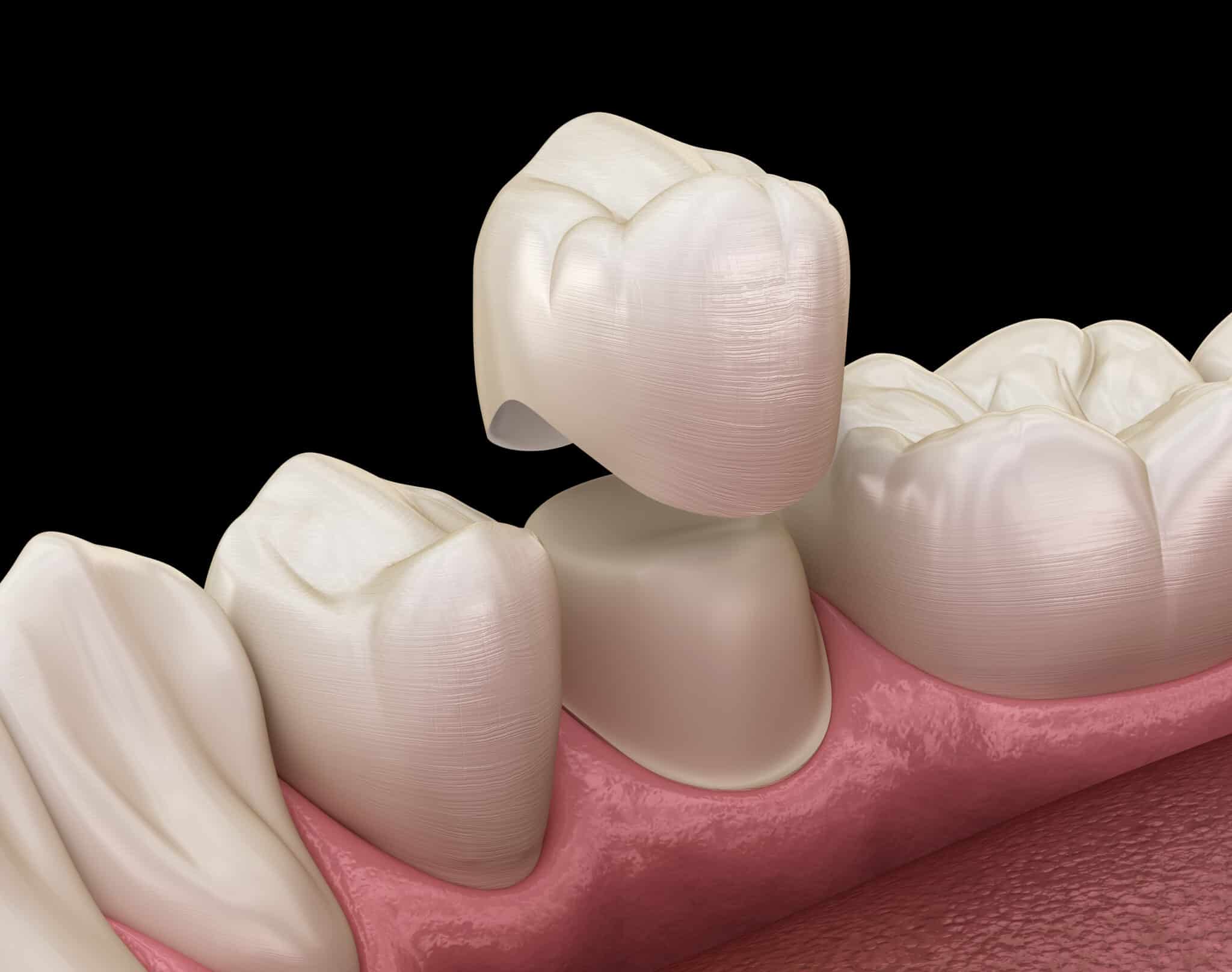 Why should you consider veneers in escondido Campbell Dental Arts dentist in escondido ca