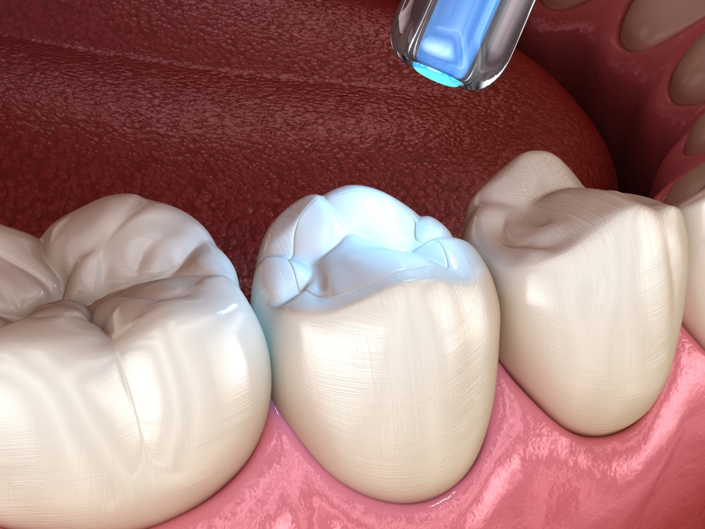 fillings dental filling Campbell Dental Arts dentist in escondido ca