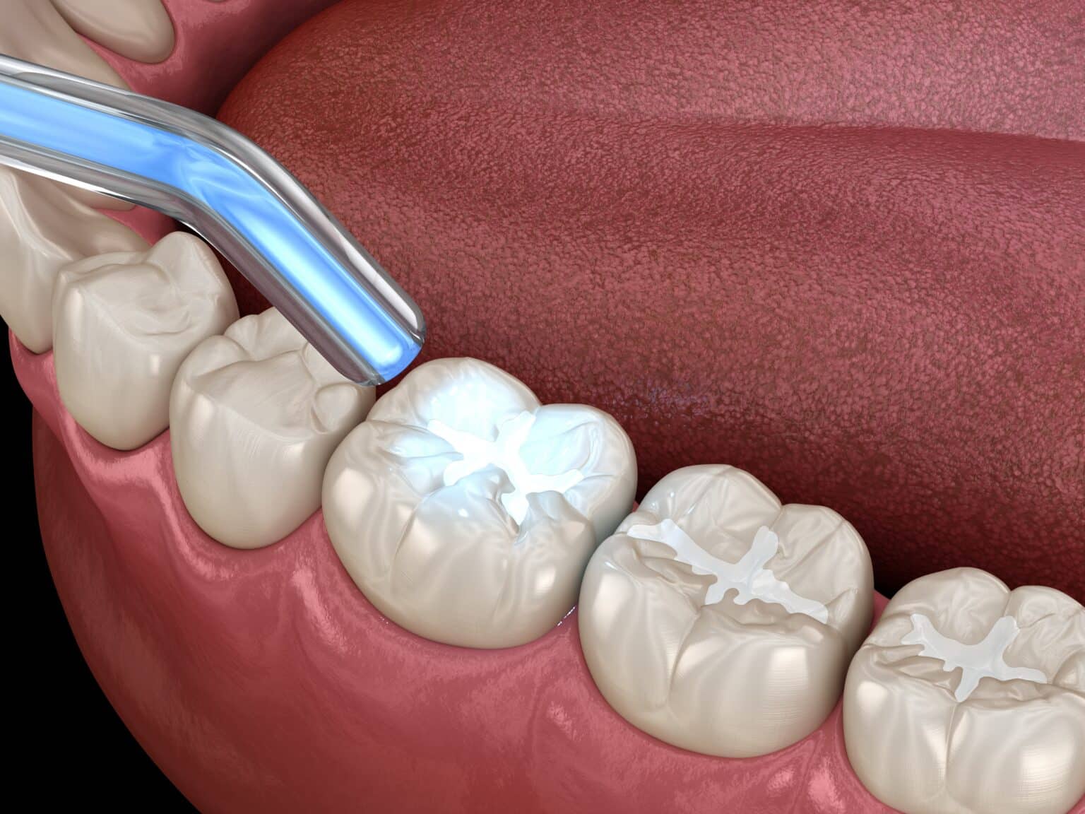 dental fillings escondido