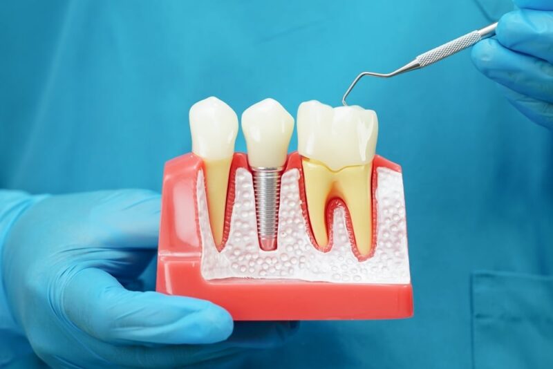 dental implants escondido